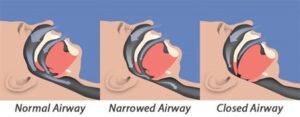 Airway closure images
