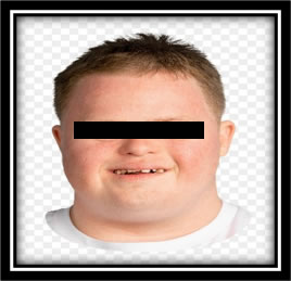 Down Syndrome